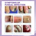 Gray Nail Care Spray Soft Ingrown Nails, Ingrown Nails, Yellowing And Thickening Cleaning Care