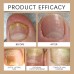 Onychomycosis Care Spray, Nail Spray Soft Nail Thick Nail Antibacterial Spray Onychomycosis Care Spray, Nail Spray Soft Nail Thick Nail Antibacterial Spray