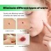 Skin Tag Removal Rubber Band, Remove Moles Remove Warts Face Neck Flesh Granule Body Cleansing Soap