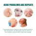 EELHOE Star Acne Patch Gentle Cleansing Lighten Acne Soothing Skin Acne Patch Facial Cleansing Treatment
